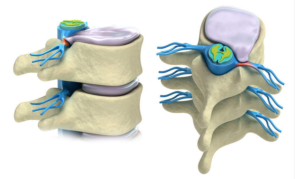 How Chiropractic Care Helps Disc Herniation