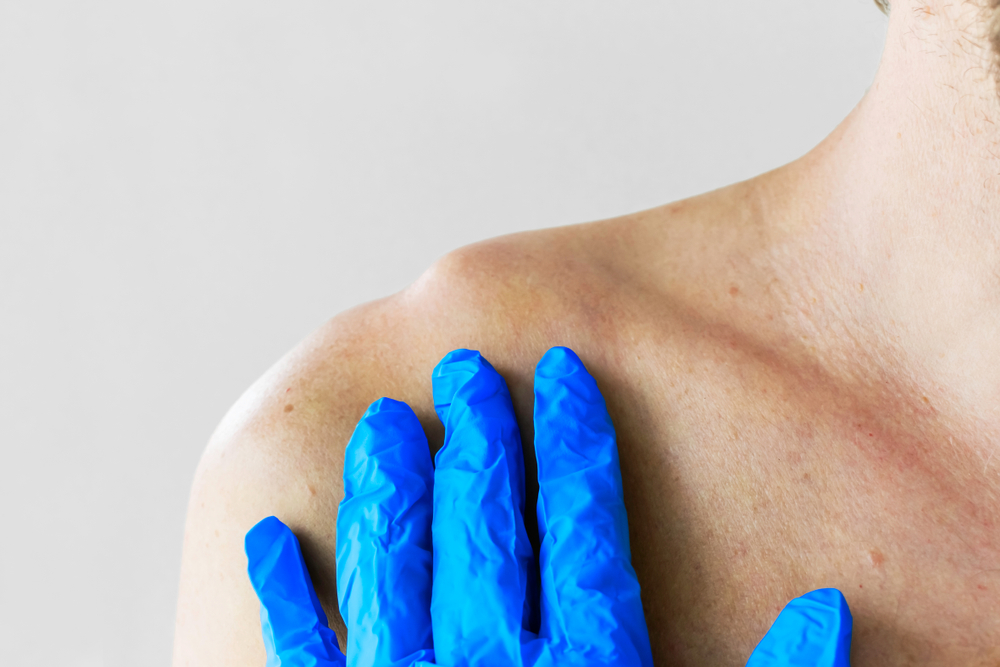 What to Do If You Suspect a Shoulder Dislocation After an Accident